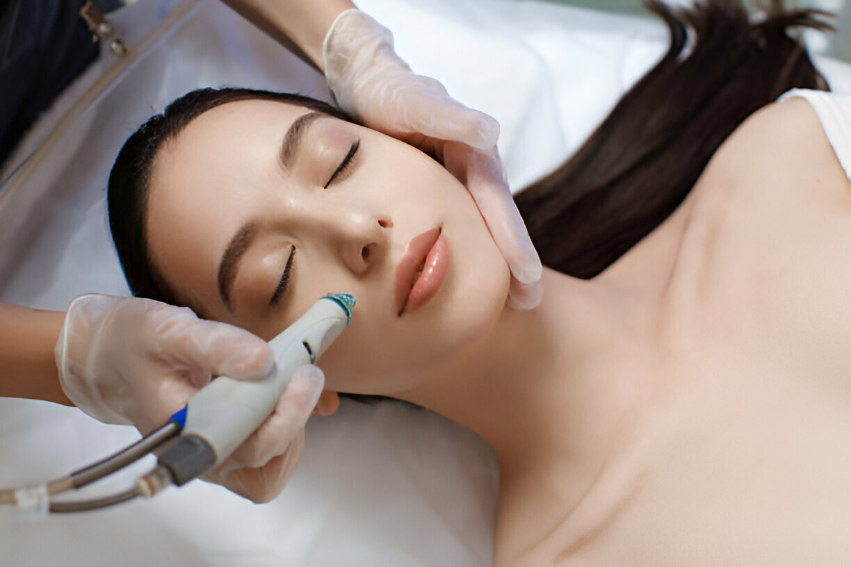 microneedling gevelsberg